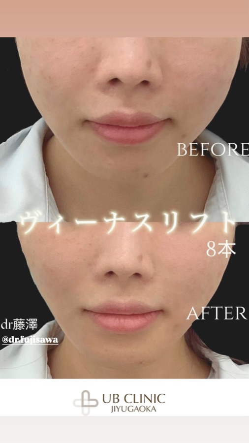 ヴィーナスリフト8本の症例写真
