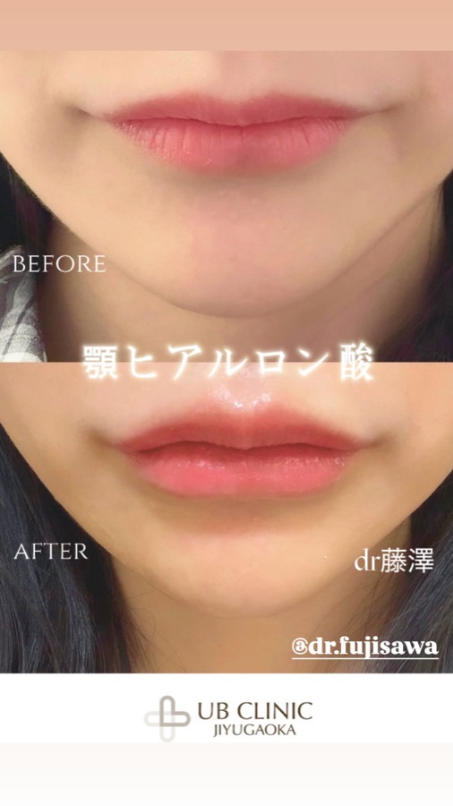 唇へのヒアルロン酸注入の症例写真