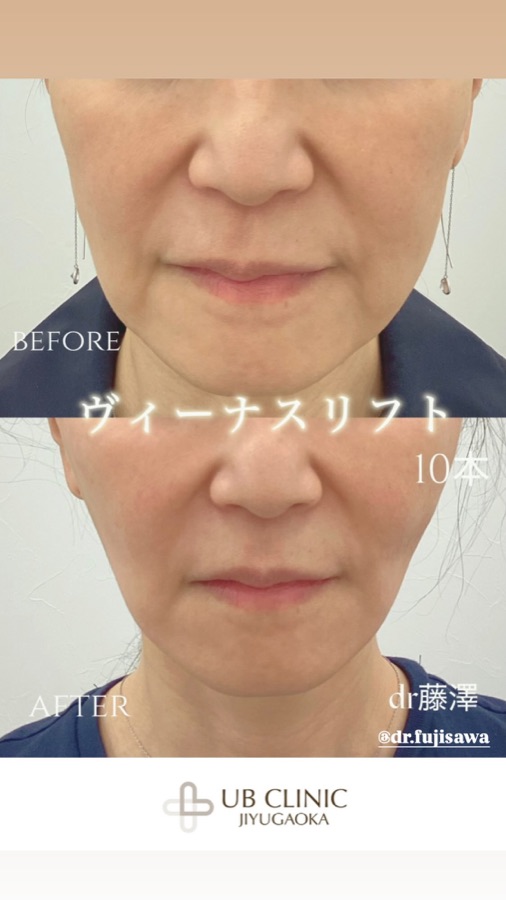 ヴィーナスリフト10本の症例写真