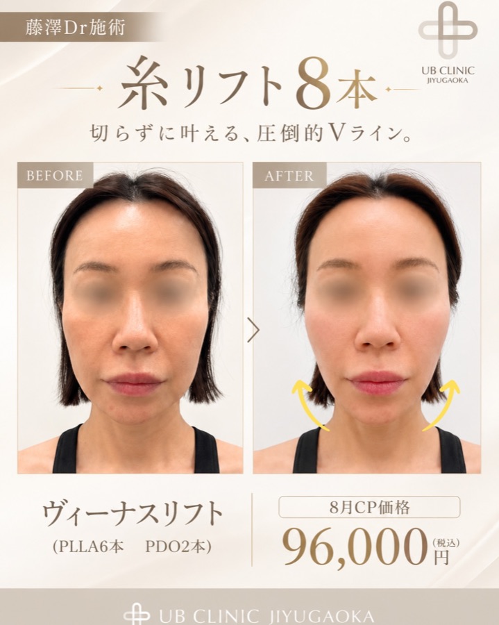ヴィーナスリフト（糸リフト）8本の症例写真